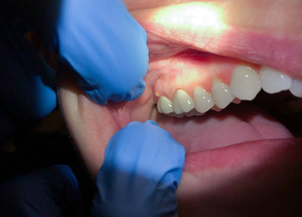 Best Emergency Dental Care for Broken or Chipped Teeth in Waynesville, OH