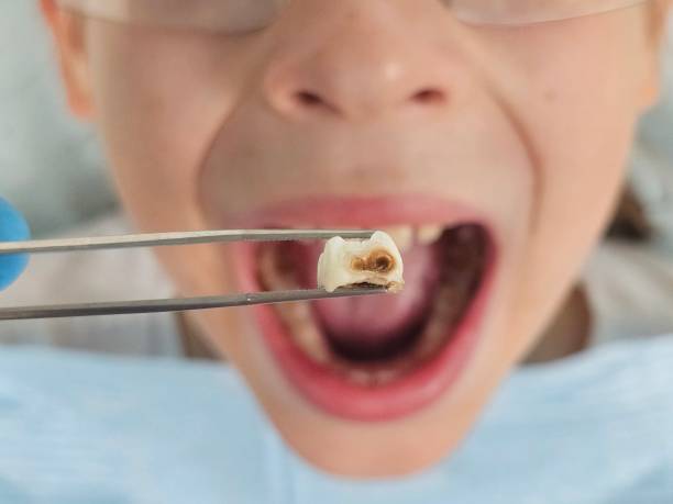 Best Pediatric Emergency Dentist in Waynesville, OH