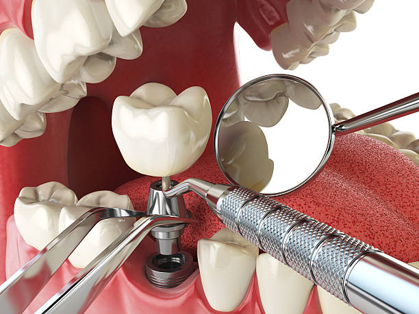 Best Emergency Dental Care for Broken or Chipped Teeth in Waynesville, OH